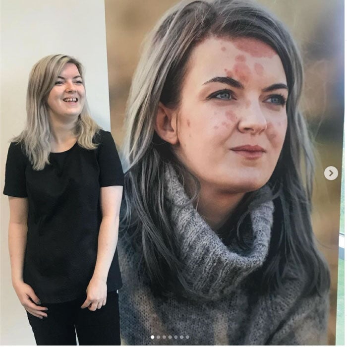 Advice on Managing Your Skin from a Psoriasis Advocate