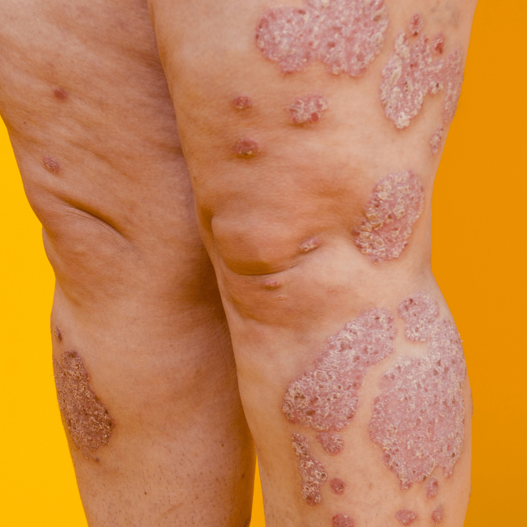 Dead Sea Salt for Eczema & Psoriasis