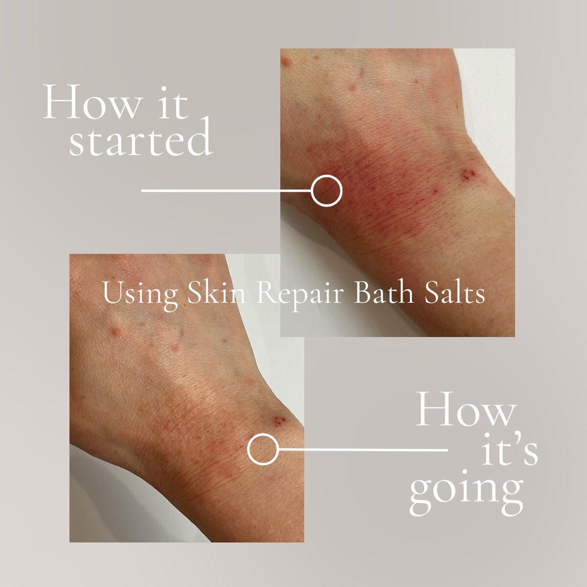 Bio Salt Itching Rash Skin Repair Bath Salt - Relief for Skin Conditions Eczema & Psoriasis ...